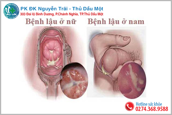 Tiểu ra mủ trắng vàng coi chừng mắc phải bệnh lậu