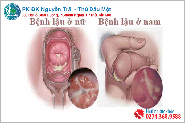 Niệu đạo chảy mủ do bệnh lậu