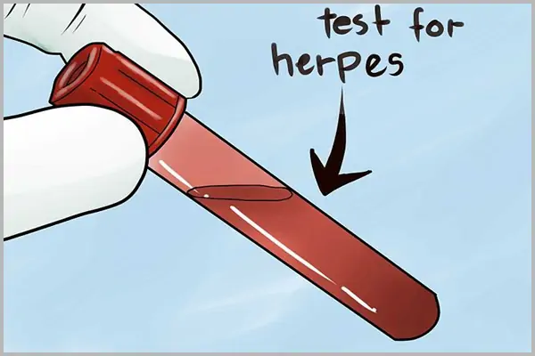 Xét nghiệm herpes và xét nghiệm HSV