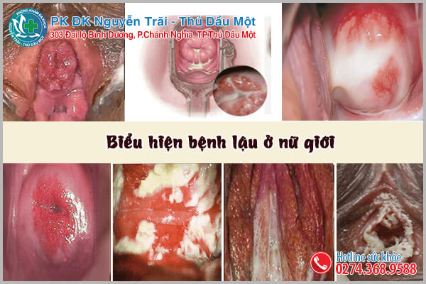 Những hình ảnh của bệnh lậu ở nữ giới